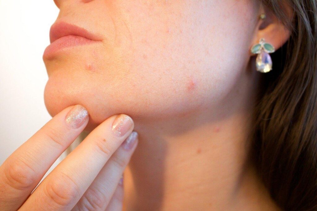 Reduce Your Acne Scars With Lasers and Lights
