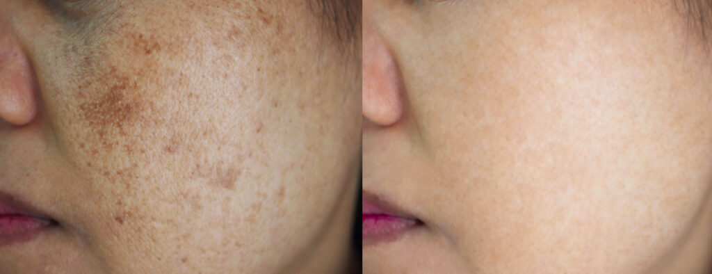 How to Reduce Melasma With Laser Treatment
