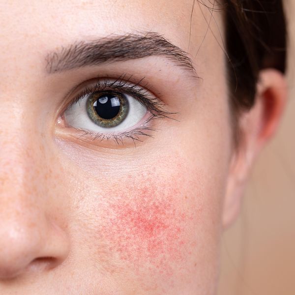 How to Reduce Rosacea Naturally With Laser Treatment