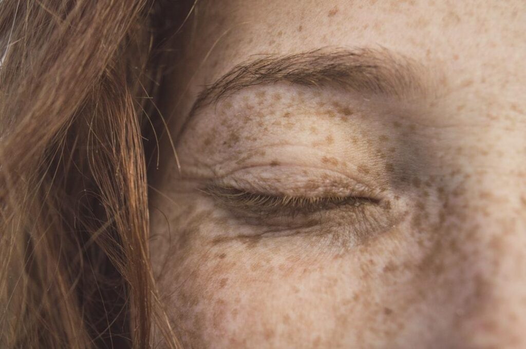 Freckle Removal: What It Is and How It Works