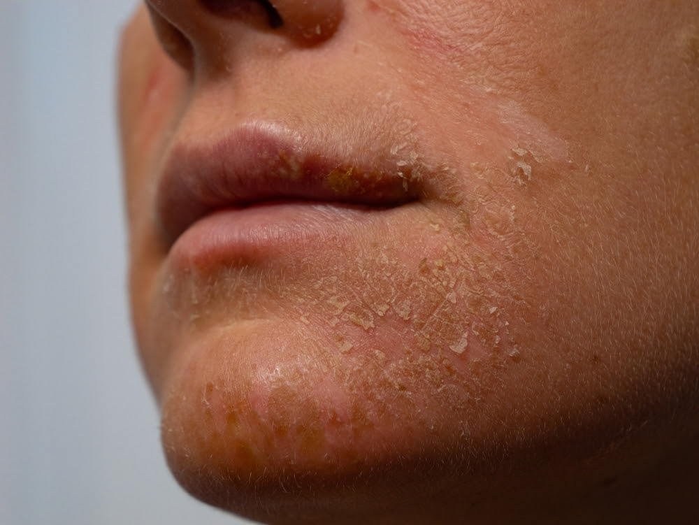 Damaged Skin Barrier: Signs You’re Overdoing Skincare, and How to Repair It